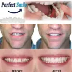 Adjustable Snap-On Dentures - Image 2