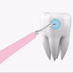 Ultrasonic Tooth Cleaner - Image 5